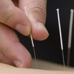 acupuncture sante tradition yannick bizien